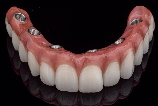 What Are The Steps In The All On Dental Implant Procedure?