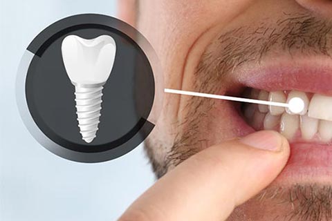 Dental Implants