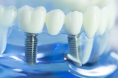Full Mouth Implant