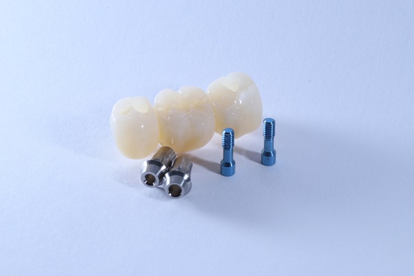 Implant Supported Bridge FAQs